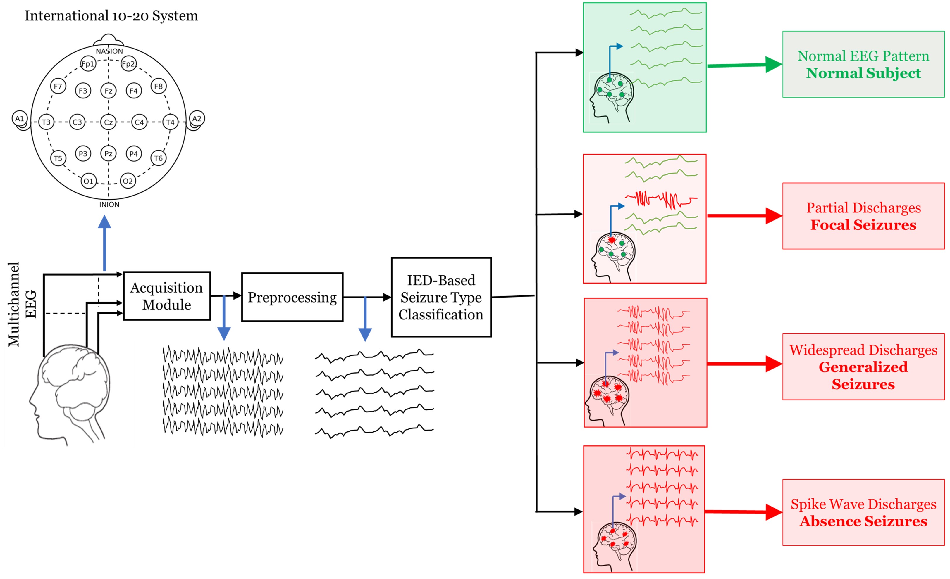 IED Pattern Extraction for Epileptic Seizure Detection